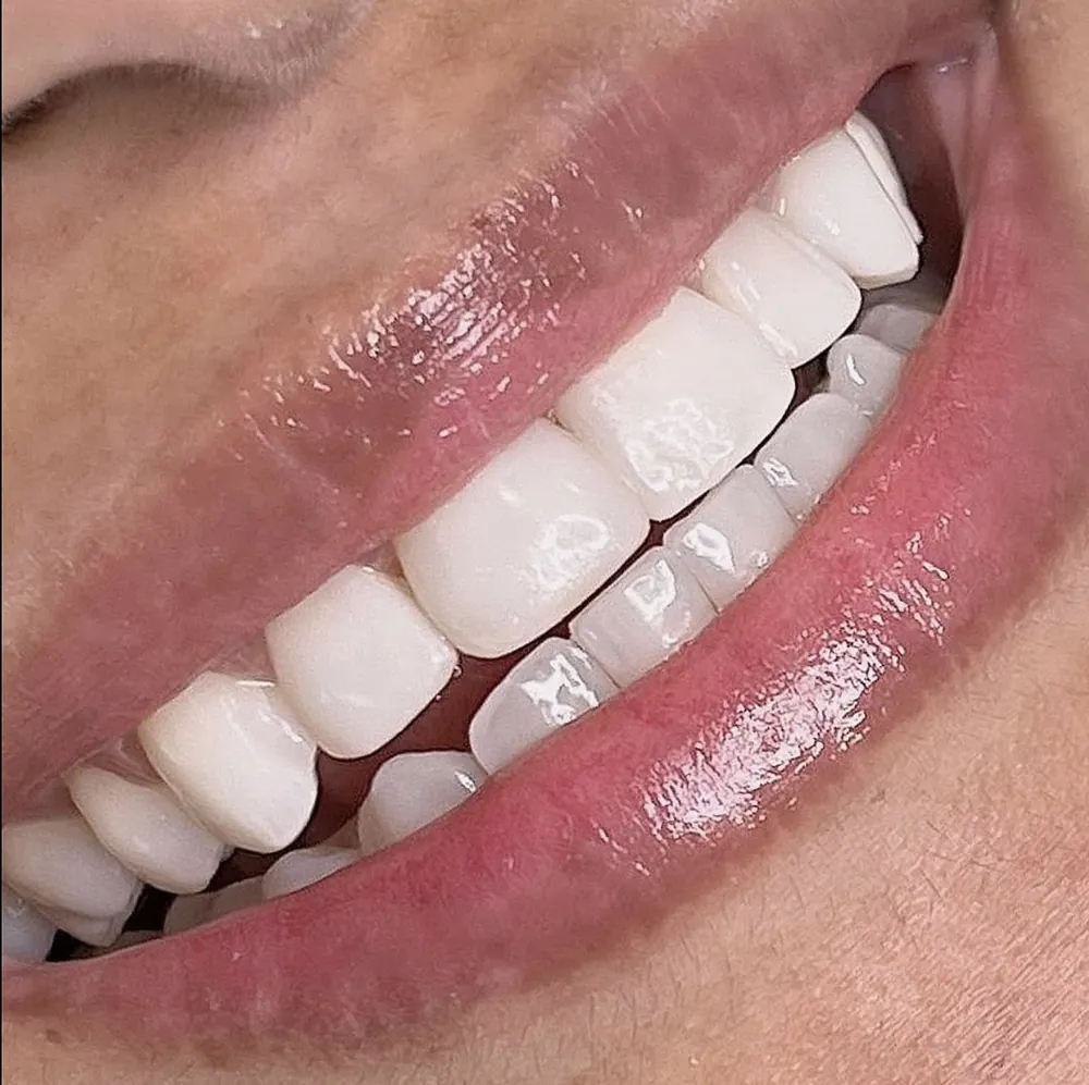 Sorriso com facetas em porcelana visto de lado