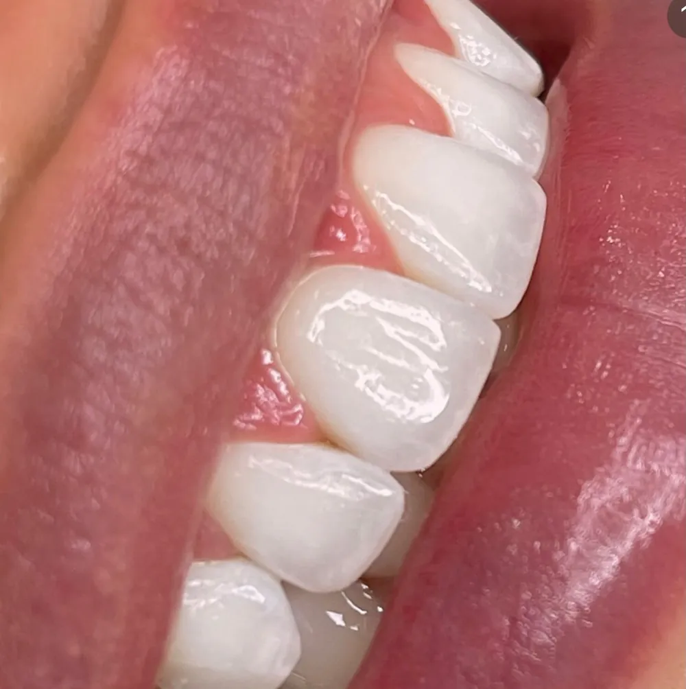Close das facetas em porcelana com brilho natural
