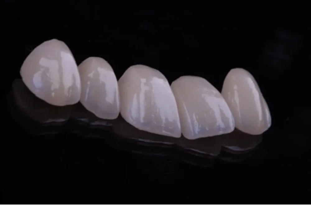 Facetas em porcelana prontas, sobre fundo escuro