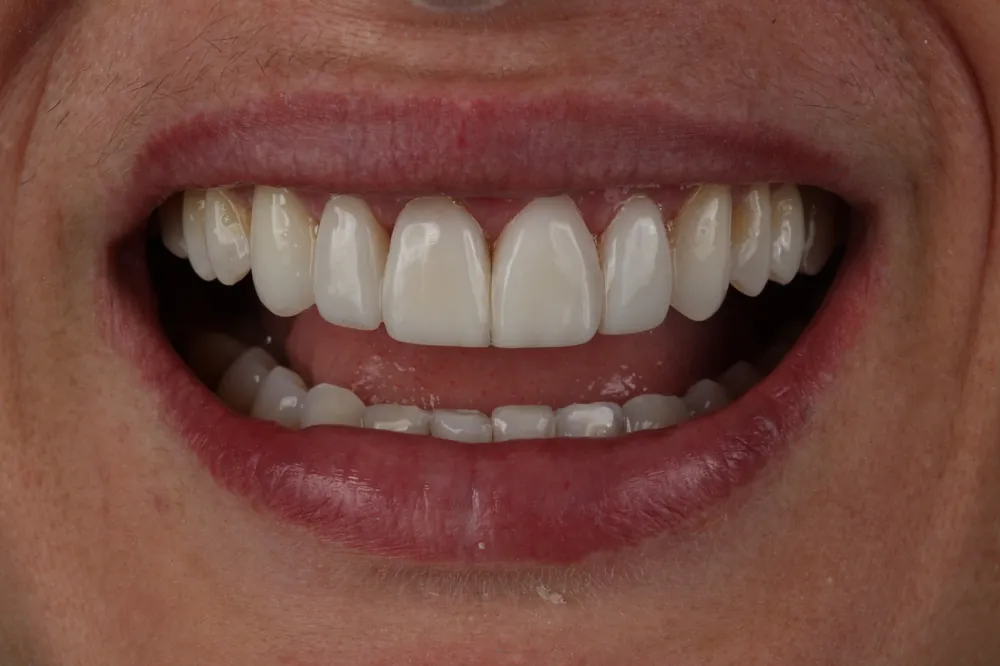 Sorriso com facetas em porcelana visto de frente